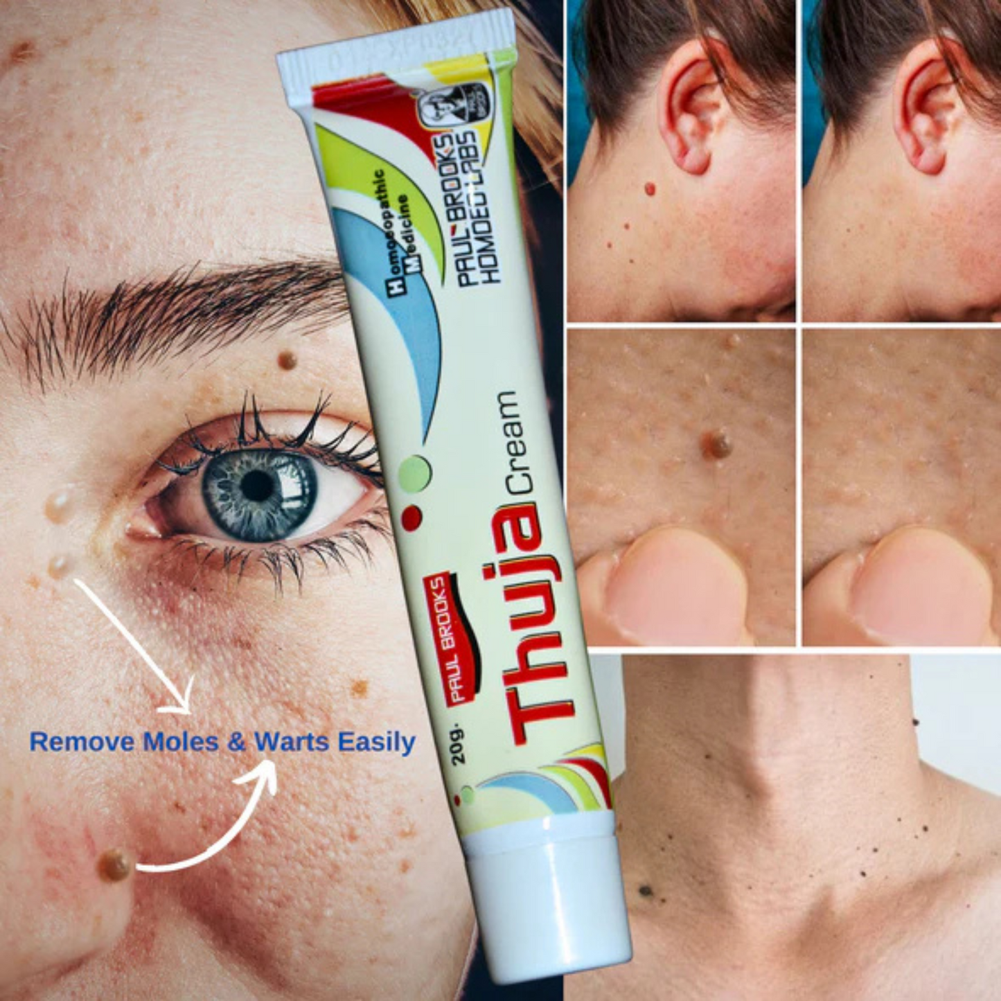 Thuja Cream – Natural Herbal Solution for Warts & Moles Removal