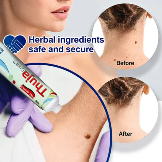 Thuja Cream – Natural Herbal Solution for Warts & Moles Removal
